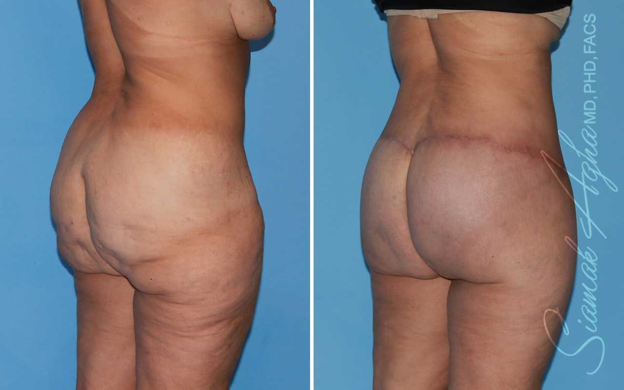 Lower Body Lift Before & After