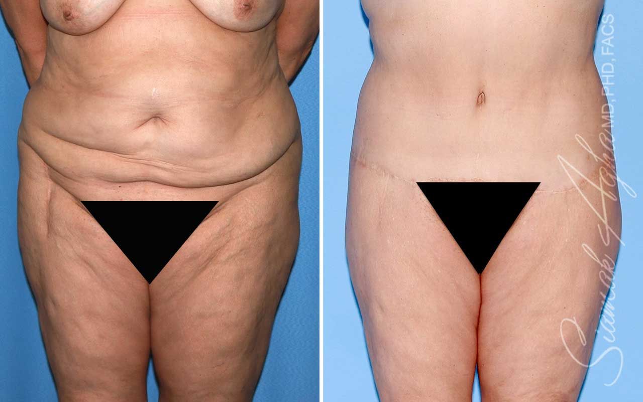 Lower Body Lift Before & After