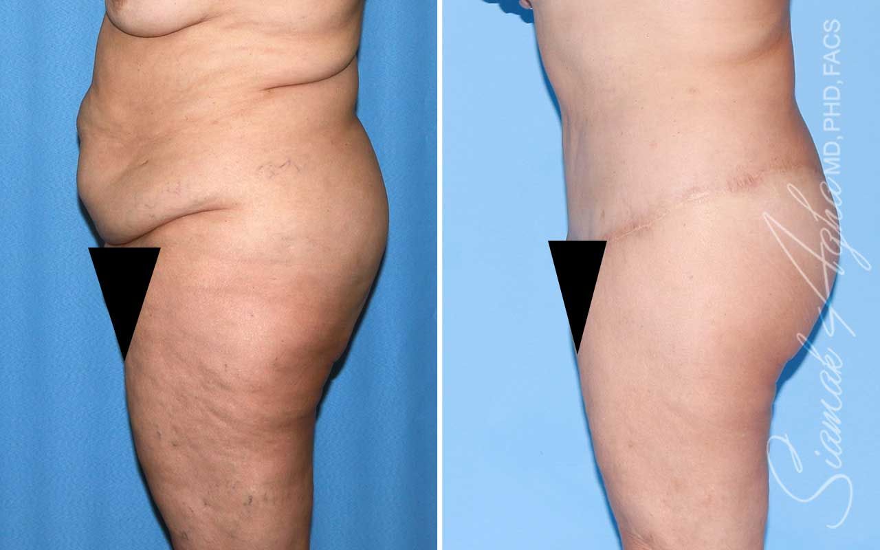 Lower Body Lift Before & After