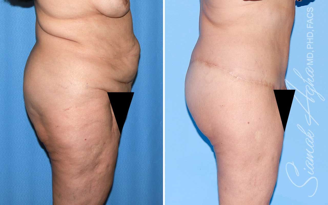 Lower Body Lift Before & After