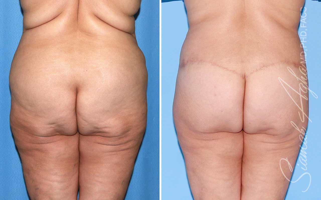 Lower Body Lift Before & After