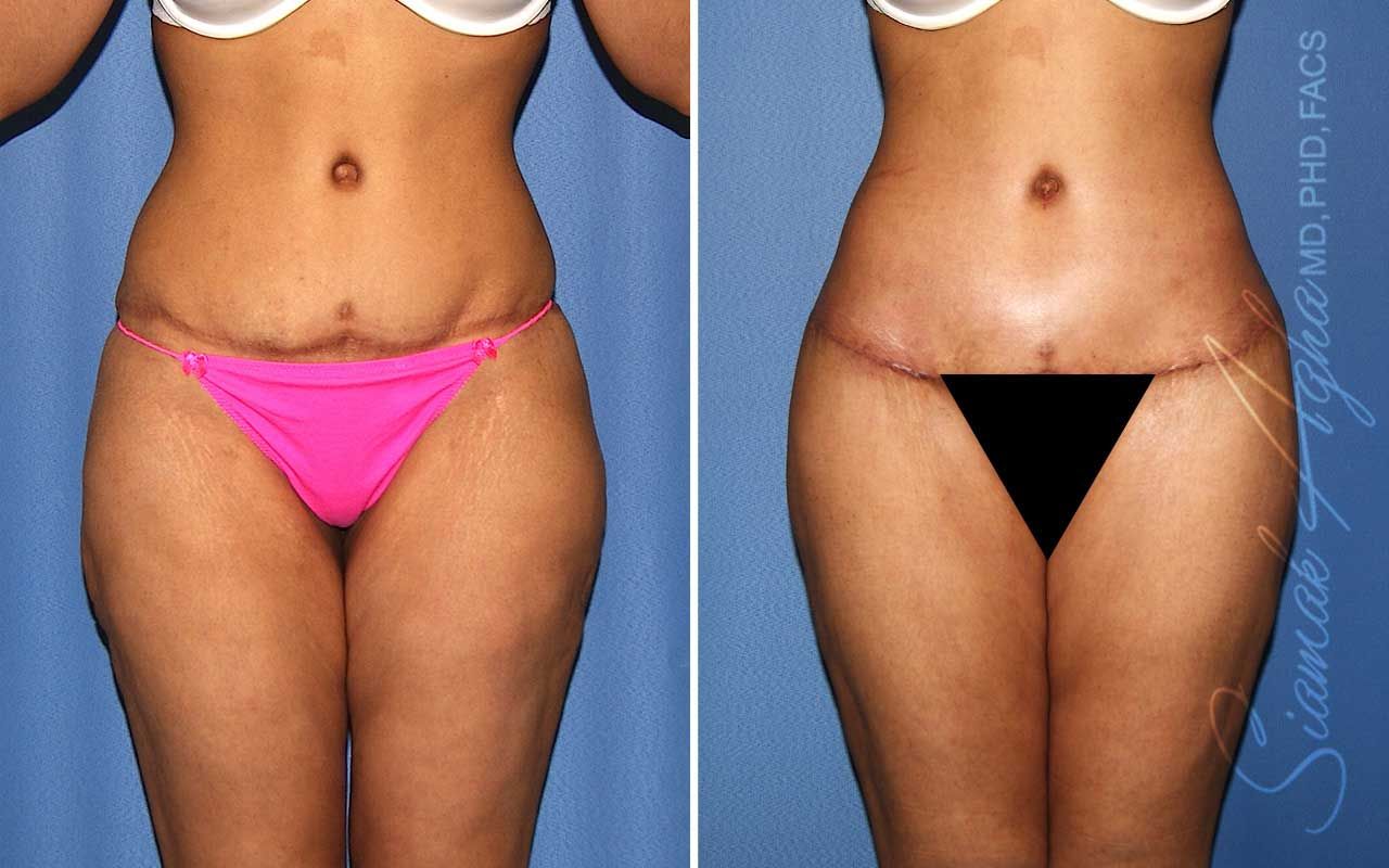 Lower Body Lift Before & After