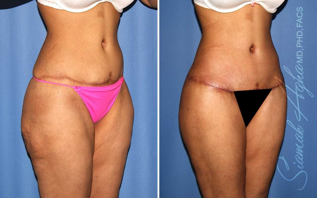 Lower Body Lift Before & After