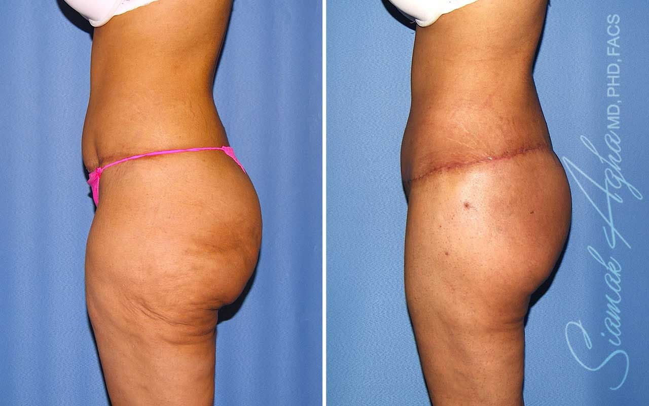 Lower Body Lift Before & After