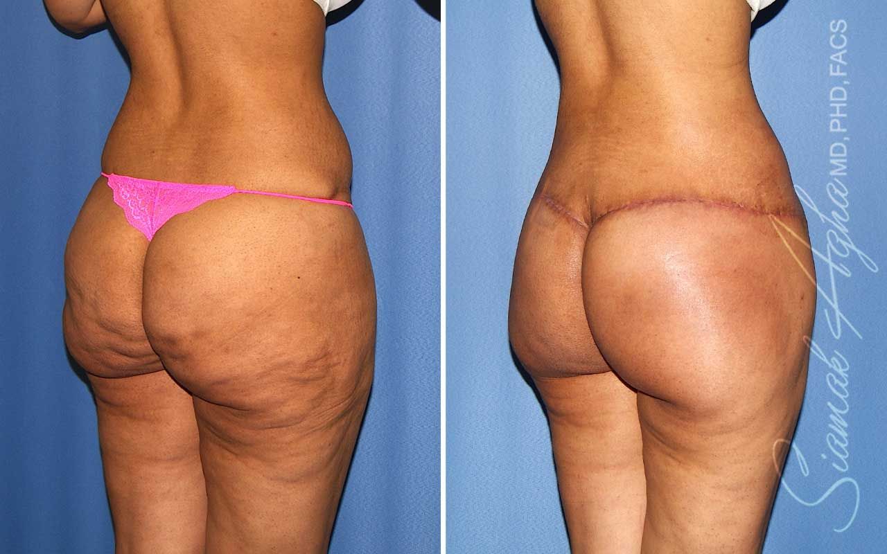 Lower Body Lift Before & After