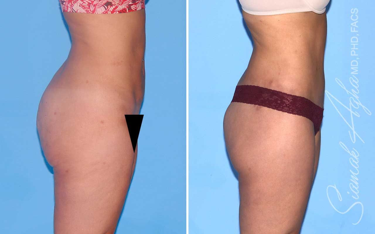 Lower Body Lift Before & After