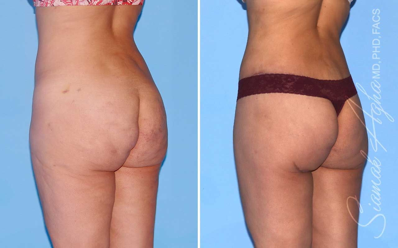 Lower Body Lift Before & After