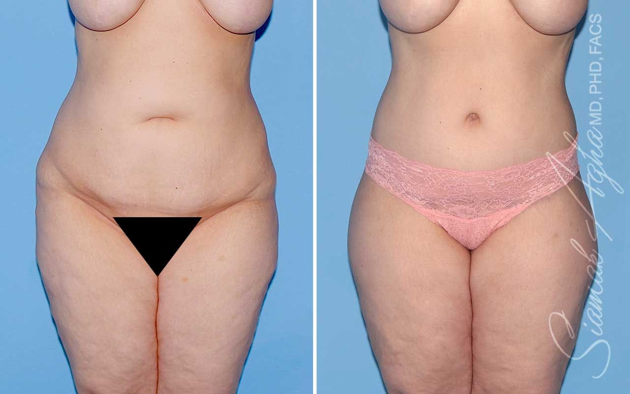 Lower Body Lift Before & After