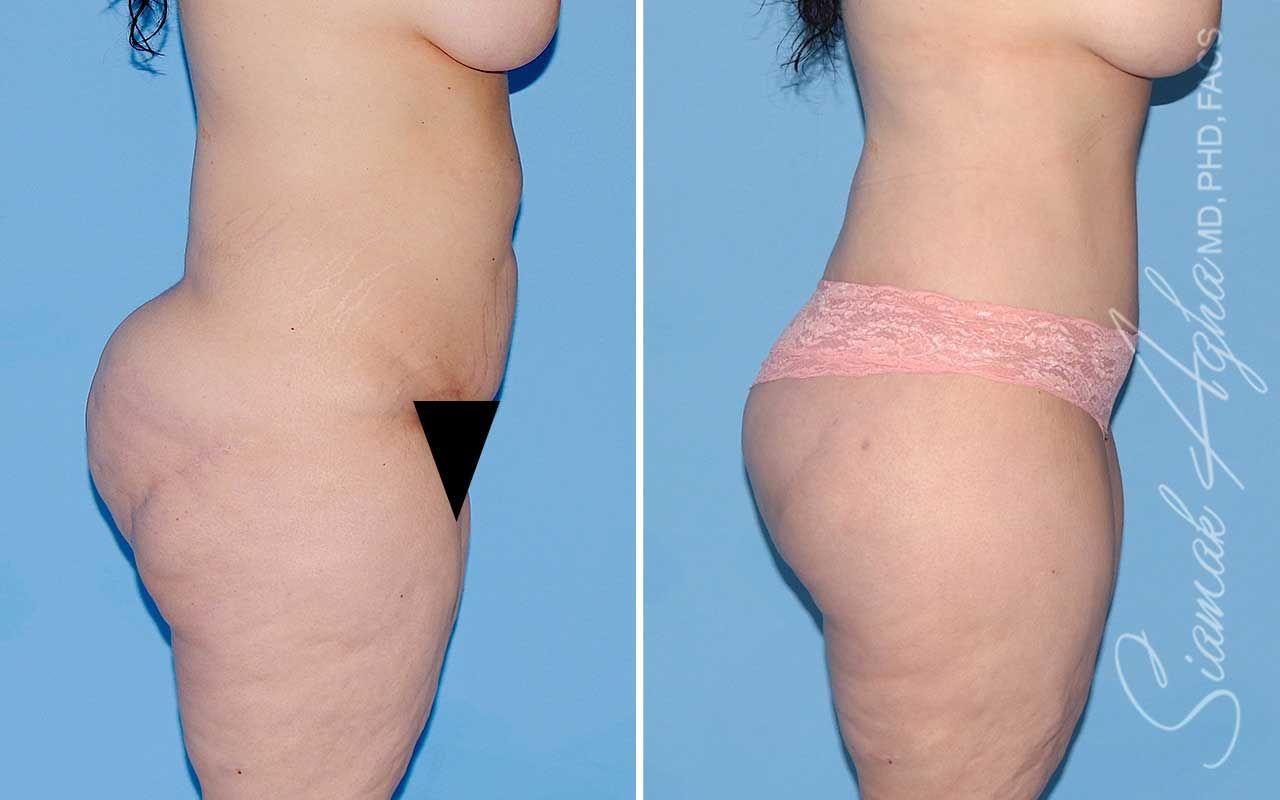 Lower Body Lift Before & After