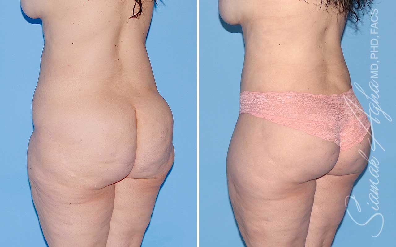 Lower Body Lift Before & After