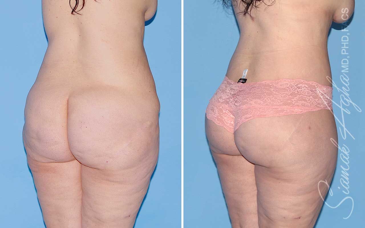 Lower Body Lift Before & After