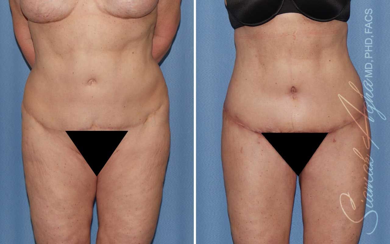 Lower Body Lift Before & After