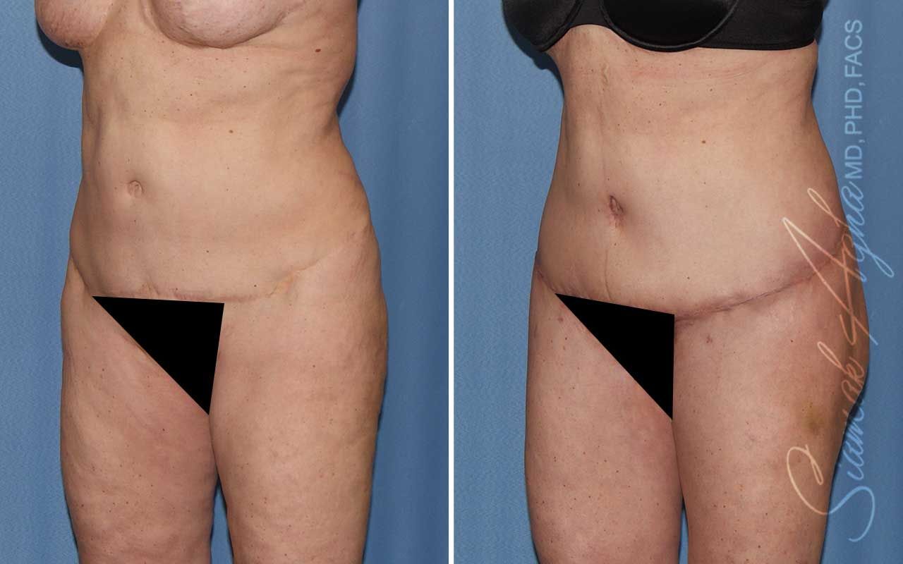 Lower Body Lift Before & After
