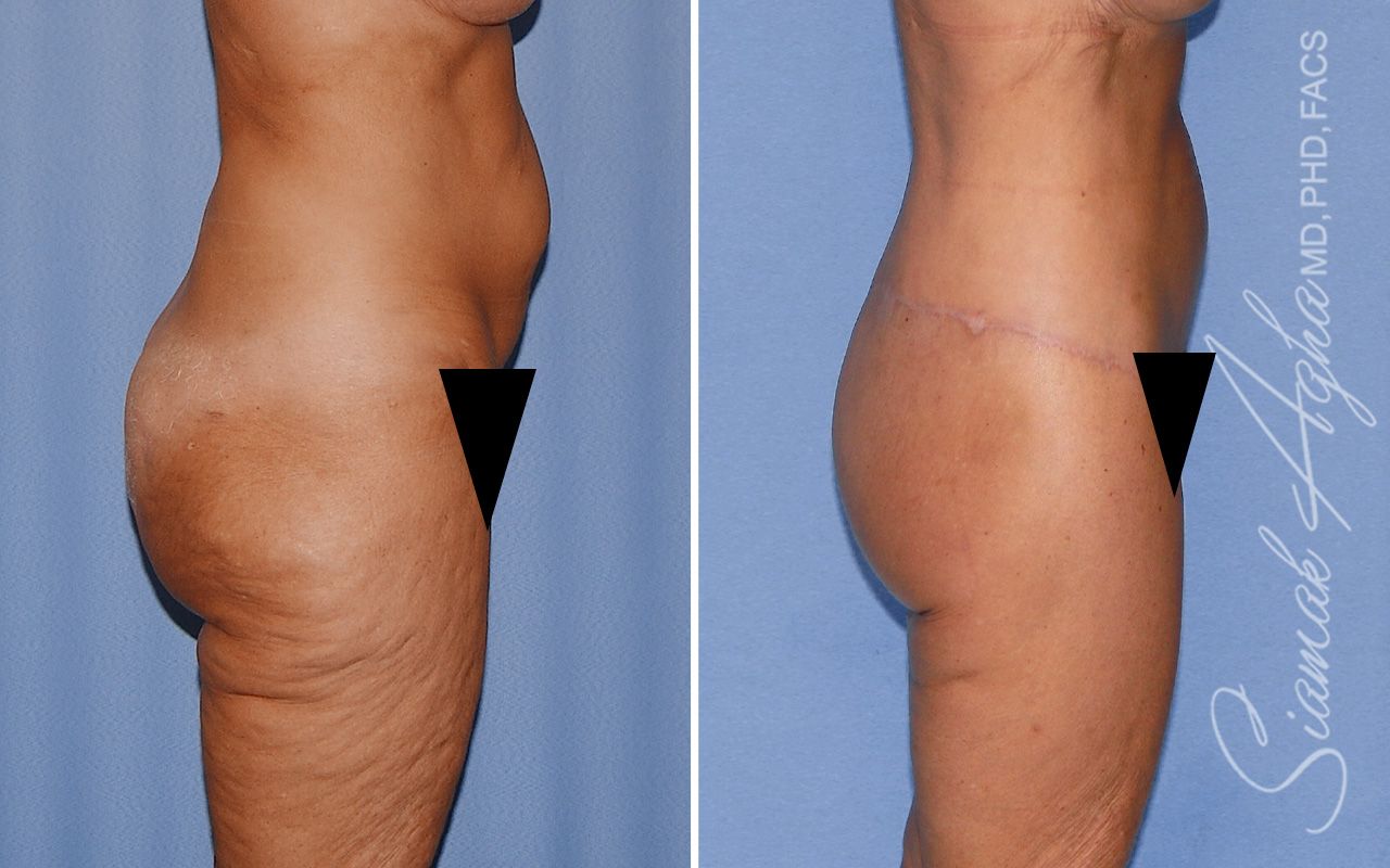 Lower Body Lift Before & After