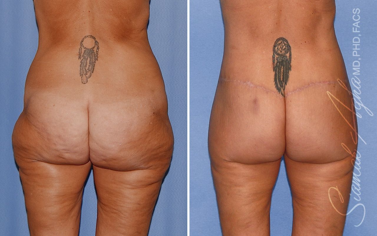 Lower Body Lift Before & After