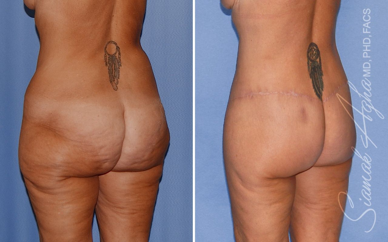 Lower Body Lift Before & After