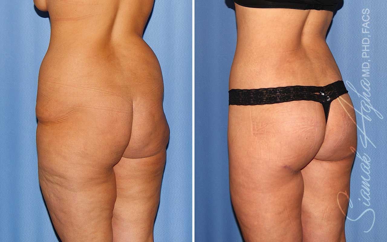 Lower Body Lift Before & After