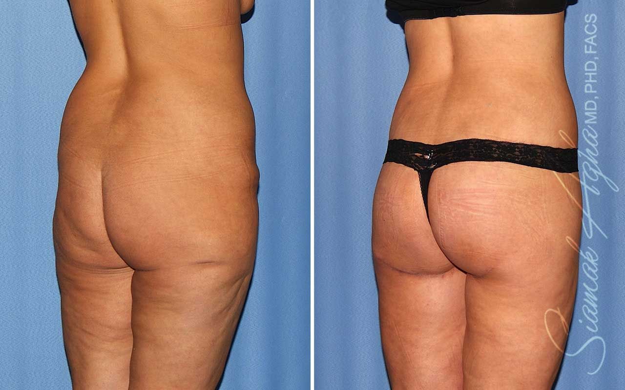 Lower Body Lift Before & After