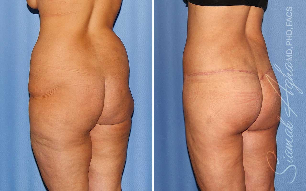 Lower Body Lift Before & After