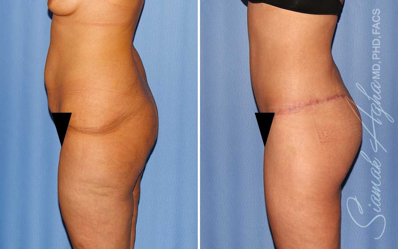 Lower Body Lift Before & After