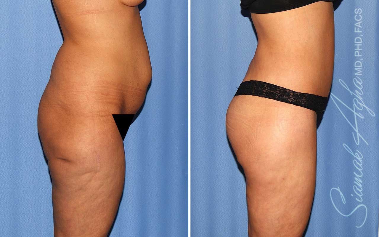 Lower Body Lift Before & After