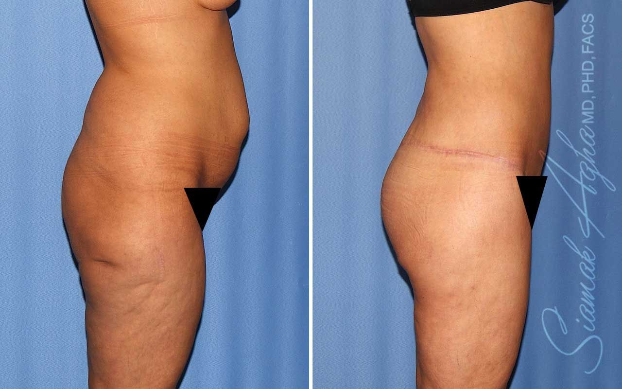Lower Body Lift Before & After