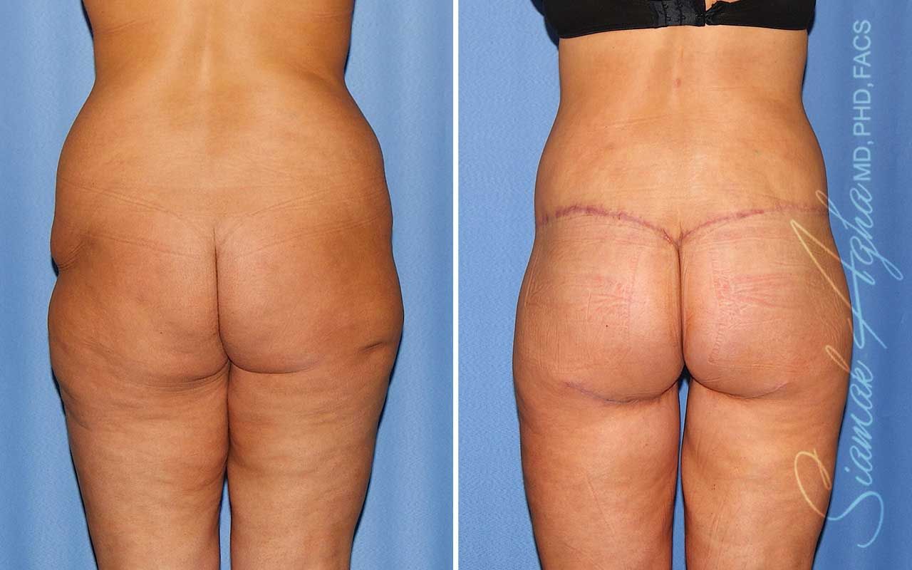 Lower Body Lift Before & After