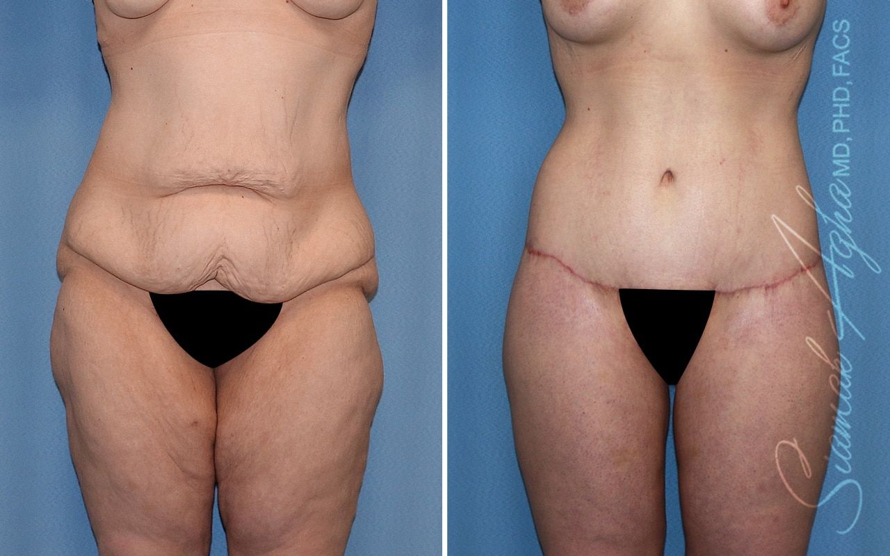 Lower Body Lift Before & After