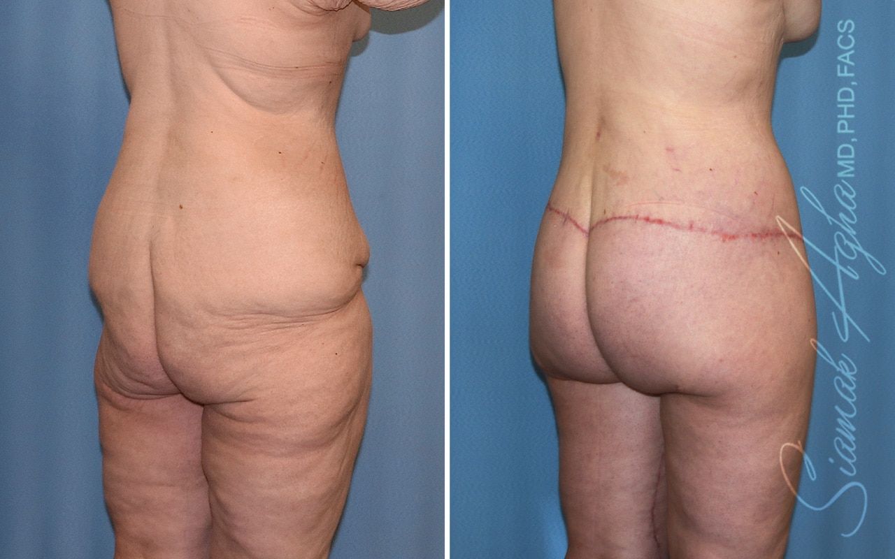 Lower Body Lift Before & After