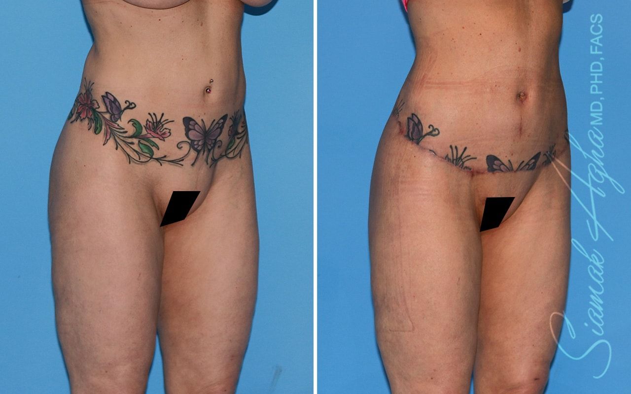 Lower Body Lift Before & After