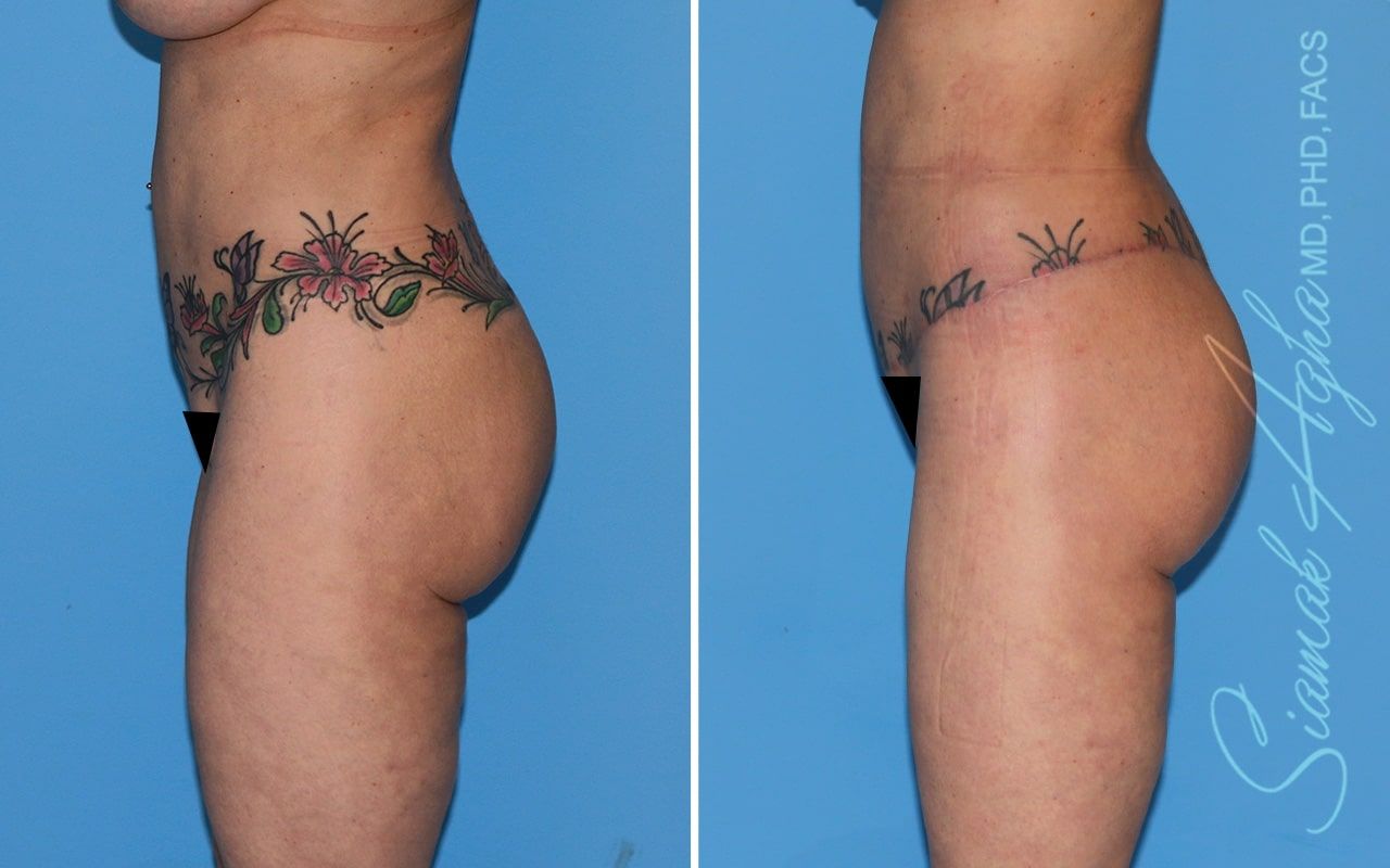 Lower Body Lift Before & After