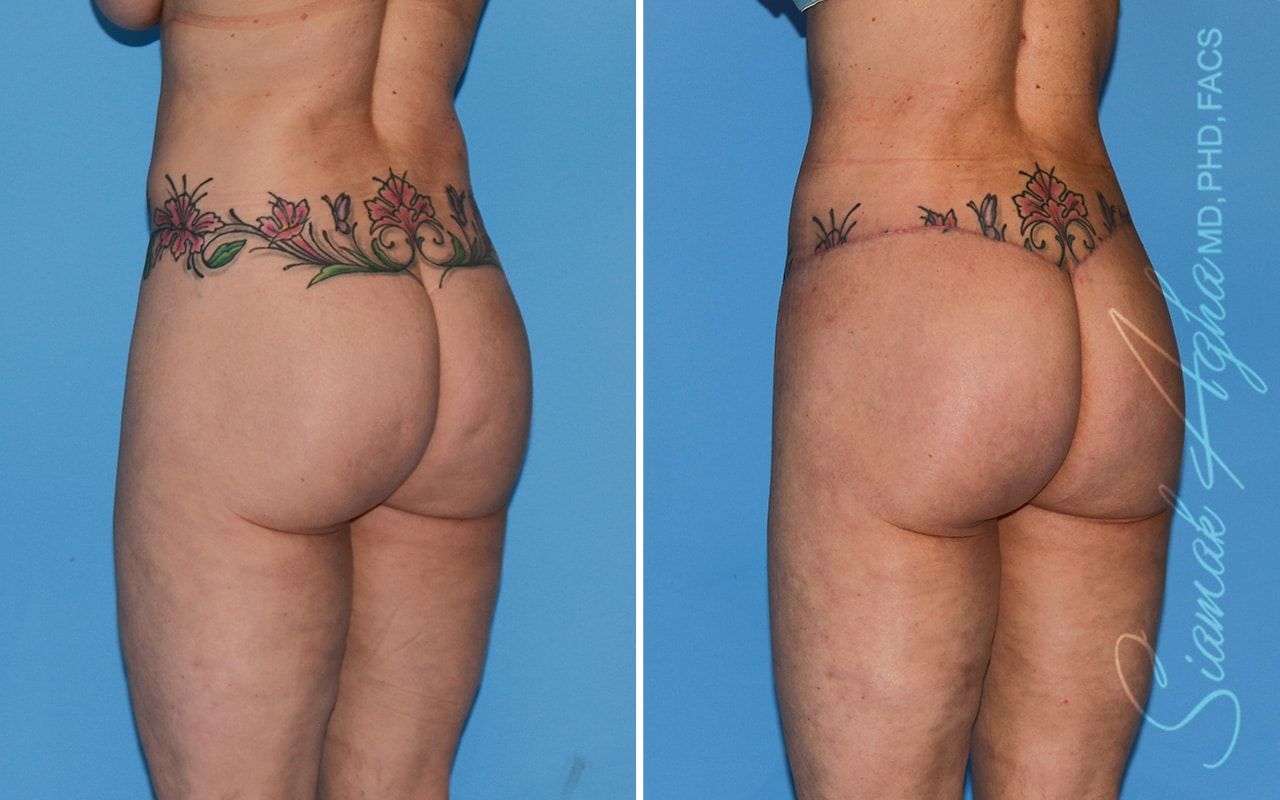 Lower Body Lift Before & After