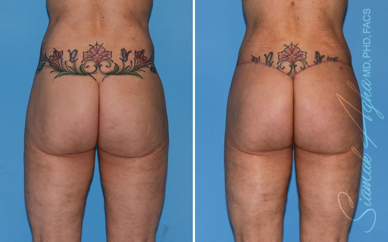 Lower Body Lift Before & After