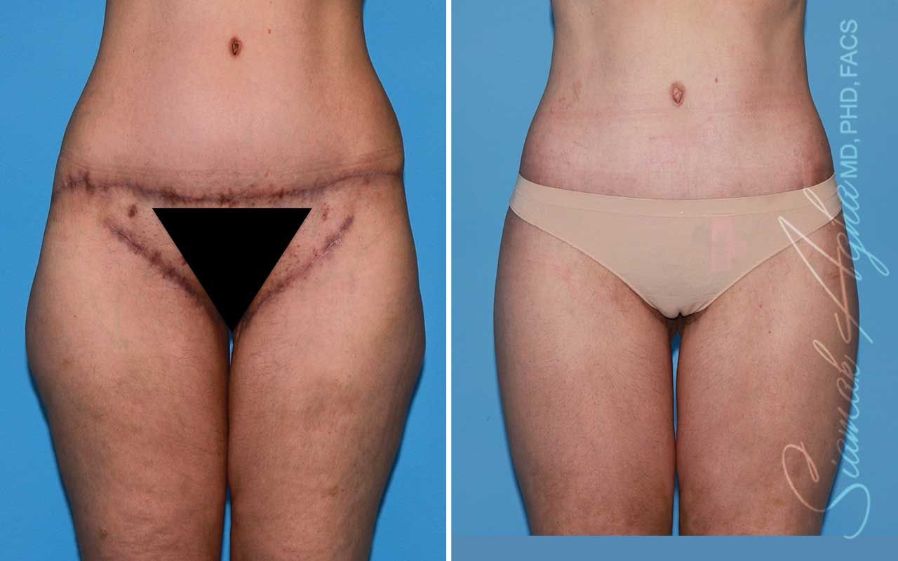 Lower Body Lift Before & After