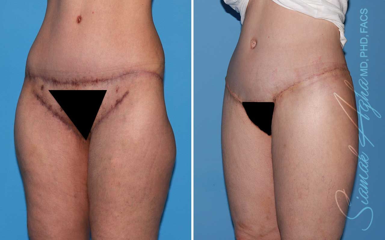 Lower Body Lift Before & After