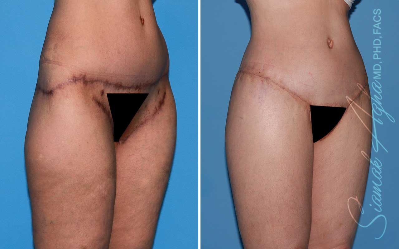Lower Body Lift Before & After