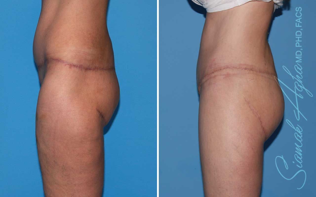 Lower Body Lift Before & After