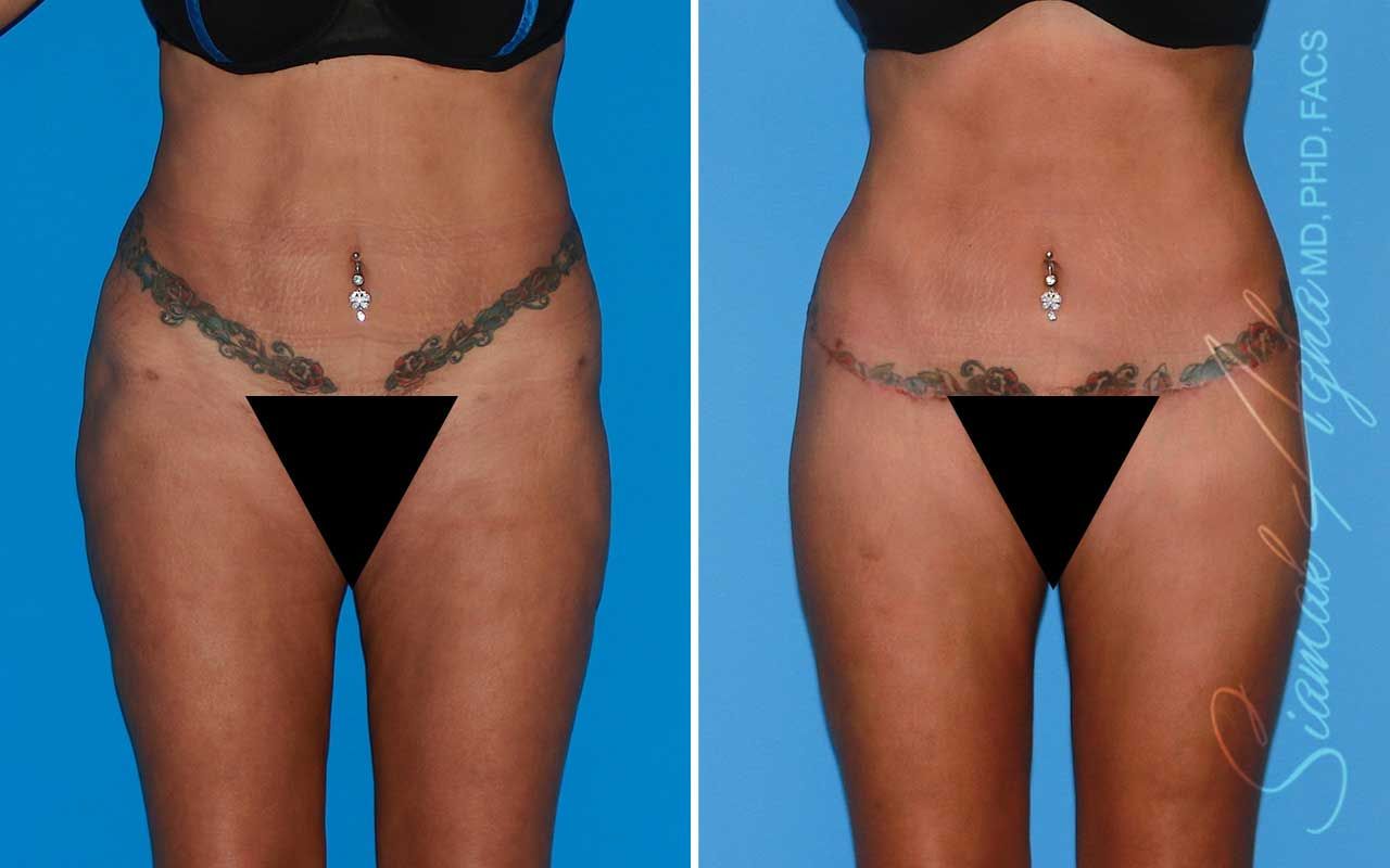 Lower Body Lift Before & After