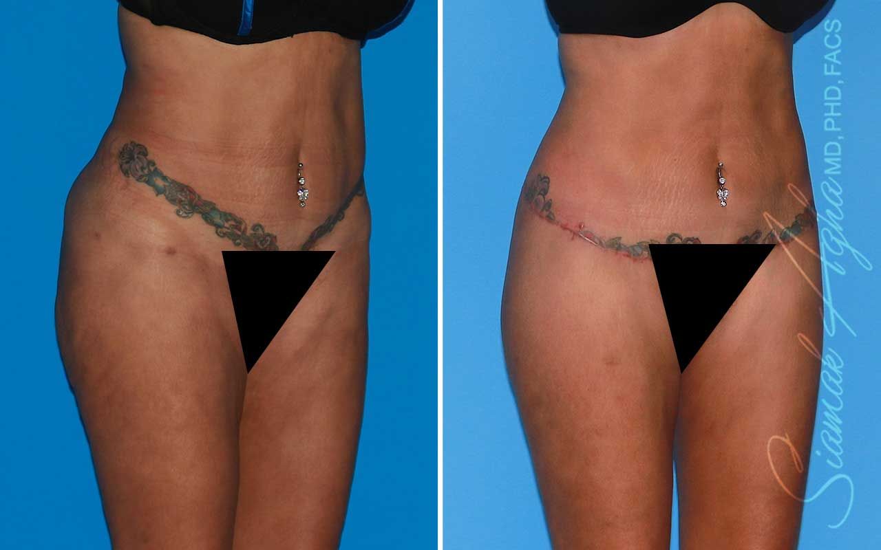 Lower Body Lift Before & After