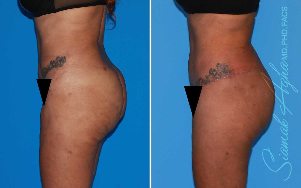Lower Body Lift Before & After