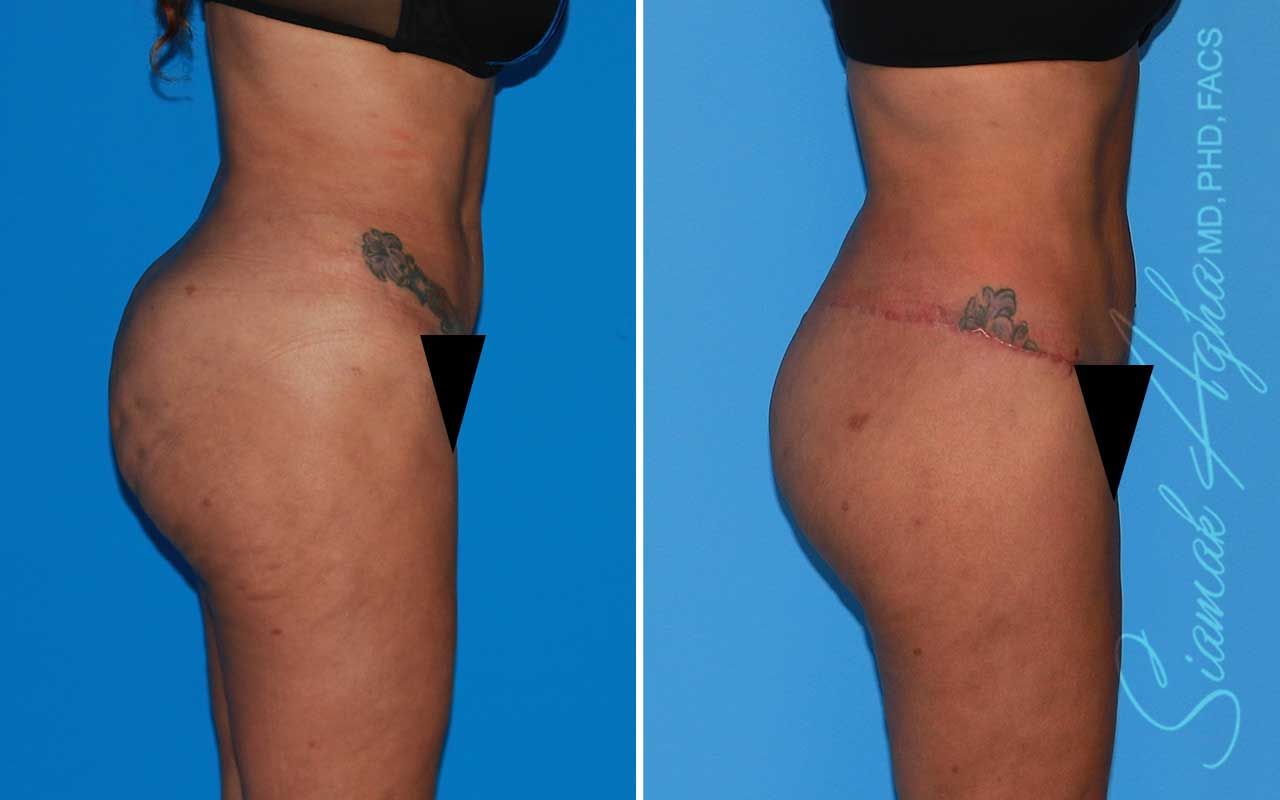 Lower Body Lift Before & After