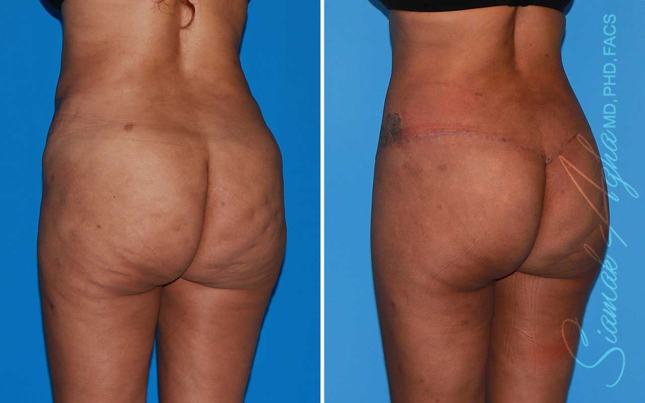 Lower Body Lift Before & After