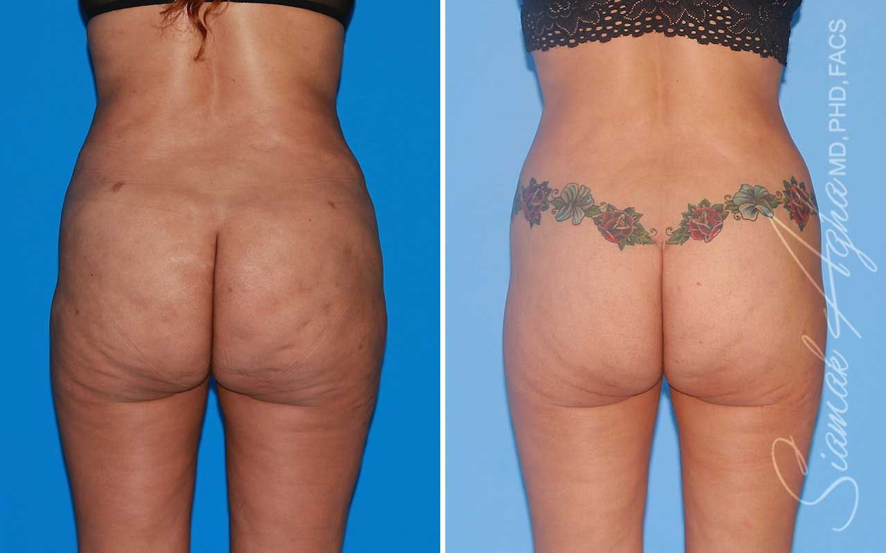 Lower Body Lift Before & After