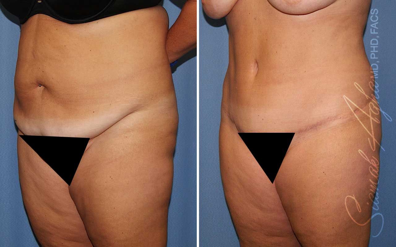 Lower Body Lift Before & After