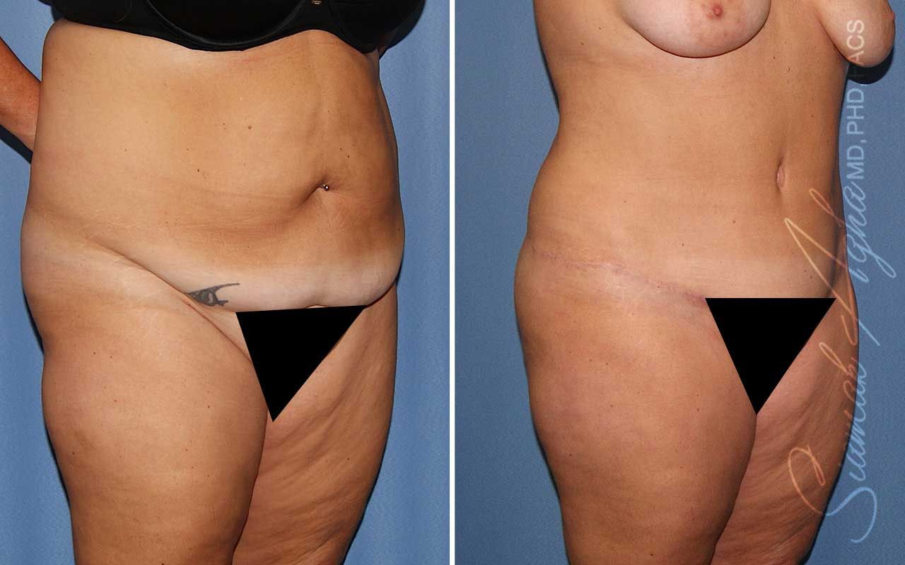 Lower Body Lift Before & After