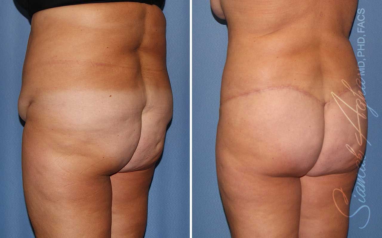 Lower Body Lift Before & After