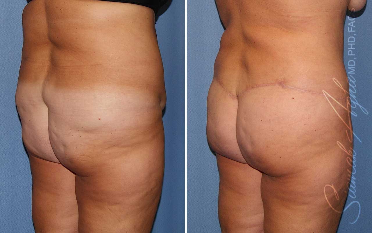 Lower Body Lift Before & After