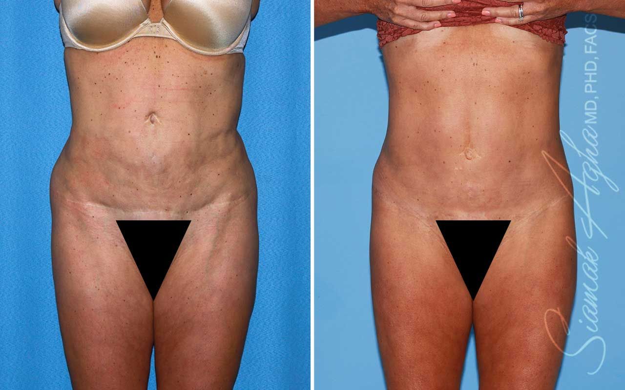 Lower Body Lift Before & After