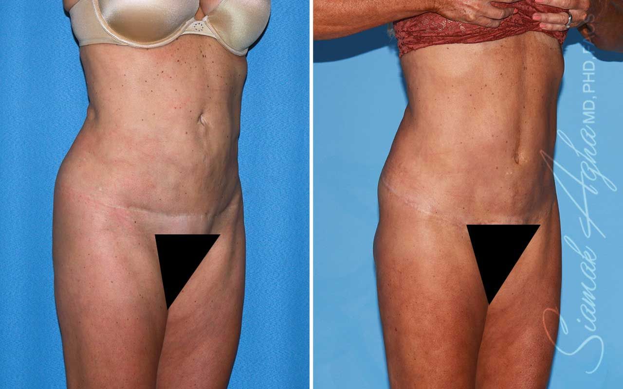 Lower Body Lift Before & After