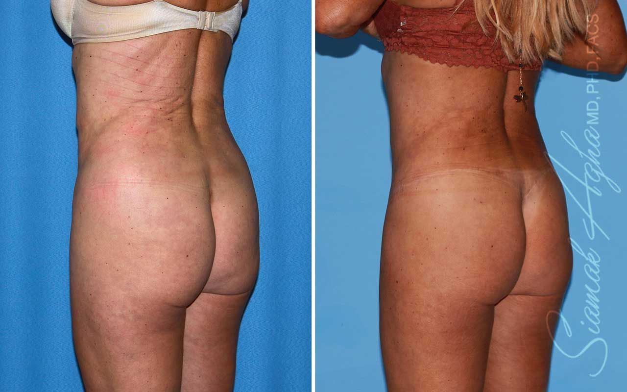 Lower Body Lift Before & After